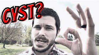 Is A Tarlov Cyst Causing Your Back Pain Or Sciatica
