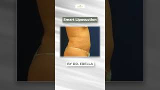 Smart Liposuction By Dr. Erella #SmartLipo