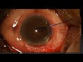 AIOC2021 - VT322 - MYX to FIX Aphakia - A Novel Technique for Sclera Fixated Intraocular...