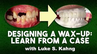 Designing A Wax-Up: Learn From A Case | Dental Lab Learning