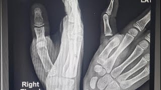 Irreducible Dislocation of metacarpophalangeal joint of thumb