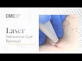 Laser Sebaceous Cyst Removal | Cosmetic Medical Clinic CMC NSW