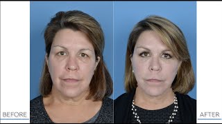 Microlift Before and After | Less invasive Facelift Operation | Dr. Greg Ruff