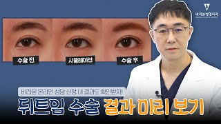 [뒤트임의 모든것 2편] 수술 전에도 수술 결과를 미리 예측할 수 있습니다!