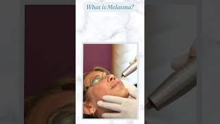 What is Melasma? #melasma