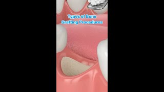 Bone Grafting