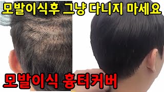 모발이식 흉터 커버중 한가지 방법입니다.