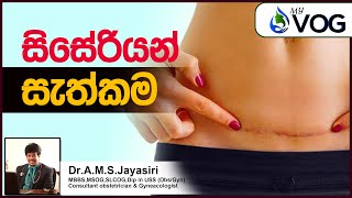 සිසේරියන් සැත්කම |  Cesarean Surgery | Dr A.M.S. Jayasiri | Health Tips | My VOG