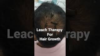 Leach Therapy For Hair Growth । #Delhi #shorts #viralshorts #baldness #hairfall #9315722881