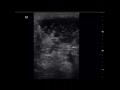 case 172 sonomammography right breast abscess cc mlo