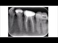 Occlusal Carries