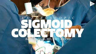 Laparoscopic Sigmoid Colectomy by Karen N. Zaghiyan, MD, FACS, FASCRS | Case Trailer