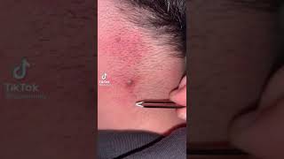 Nasty ingrown hair removal अंतर्वर्धी बाल