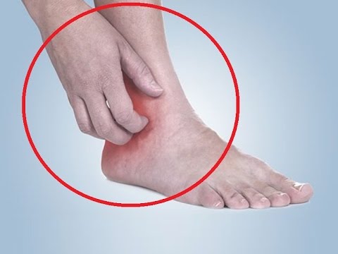 10 Beneficial Home Remedies For Leg Ulcers 10 Beneficial Home Remedies For Leg Ulcers