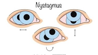 നിസ്റ്റാഗ്‌മസ് തിരിച്ചറിയുക Understanding Nystagmus: Causes and Importance of early diagnosis.