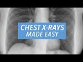 Chest X-Rays Made Easy: Learn to Read a CXR in 10 Minutes