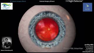 การผ่าตัดสลายต้อกระจก และใส่เลนส์แก้วตาเทียม (Cataract Surgery or Phacoemulsificaton)