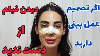 مراقبتهای قبل و بعد از عمل بینی ،برنامه غذایی ایندوران