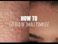 Download How to Get Rid of Small Pimples! (Accutane free) In Mp4 3Gp Full HD Video