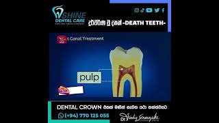 දුර්වර්ණ වු දතක් (Death teeth ) Dental crown 👑   එකක් මගින්  යථා තත්ත්වයට