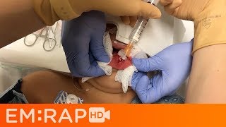 Tongue Laceration Repair with Sutures