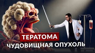 Дермоидная киста - почему в яичнике растут зубы и волосы?