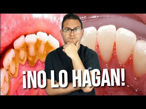 ¿Quitar El SARRO De Los DIENTES En 2 Minutos? 😎 Elimina La PLACA DENTAL ...