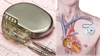 अब लाइट से धड़केगा दिल| Light is power: New pacemakers can stimulate heart muscle in a unique way