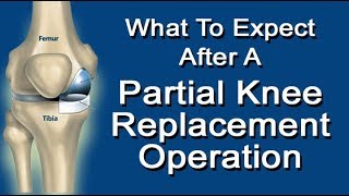 What To Expect After A Partial Knee Replacement Operation