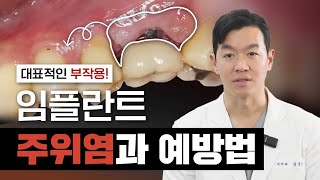 임플란트의 대표적인 부작용은 무엇일까요?