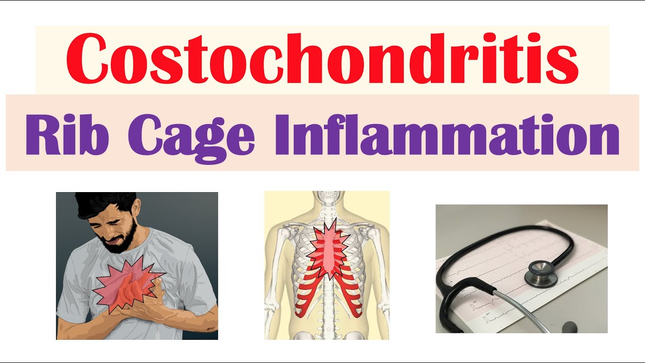 Costochondritis (Rib Cage Inflammation) | Causes, Symptoms, Diagnosis ...