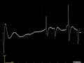 emg teaching video 1. normal insertional activity