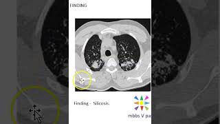 Medicine Silicosis CT image guess viva