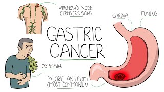 Gastric Cancer - An Overview for Students and Junior Doctors (Including Troisier's Sign)