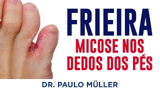 Frieira, Micose Entre os Dedos do Pé – Dr. Paulo Müller Dermatologista.