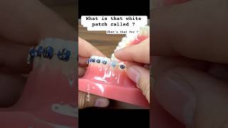 What’s is that white patch on my Braces ? Orthodontics tips