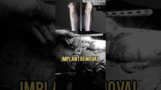 Implant Removal Surgery | Plate Removal from Tibia #ortho #fracture #shorts | Dr. Prateek Joshi