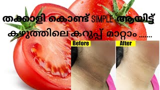 കഴുത്തിലെ കറുപ്പ് മാറ്റാം ഒരു തക്കാളികൊണ്ട്🍅🍅 | How to remove blackness from neck | Try now !!