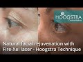 Natural facial rejuvenation with Fire-Xel laser - Hoogstra Technique (22040)