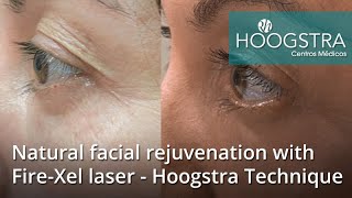 Natural facial rejuvenation with Fire-Xel laser - Hoogstra Technique (22040)