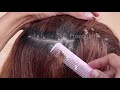 amazing big flake in my mother hair many dandruff scratching scalp 47