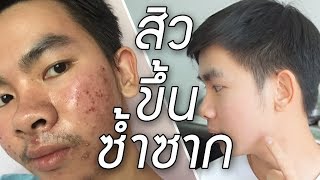 สิวขึ้นซ้ำที่เดิม สิวซ้ำซาก รักษายังไงให้หายขาด  | นุชา HAPPY NUCHA