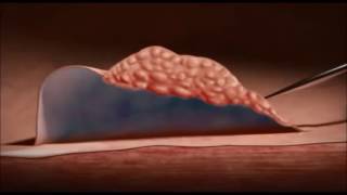 Endoscopic Mucosal Resection EMR of Polyps Animation - Chinese Simplified