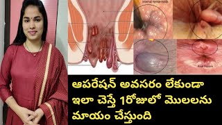 1సారి ఇలా చేస్తే చాలు ఎంతటి భయంకరమైన మొలలు, పైల్స్ శాశ్వతంగా మాయం/piles home remedies/