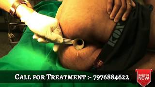 Injection for piles/hemorrhoids ( sclerotherapy)