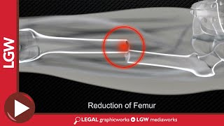 Midshaft Femur Fracture Intramedullary Nailing 3D Animation