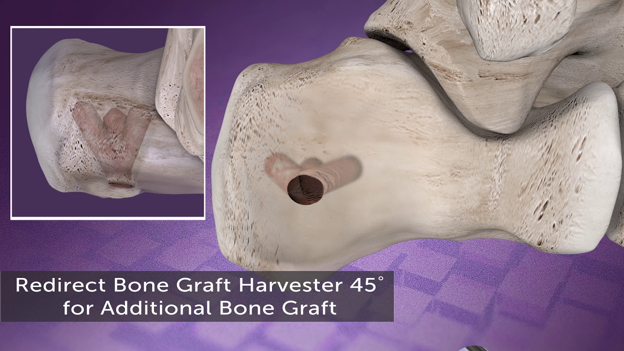 Bone Graft Harvest System Animation - YouTube