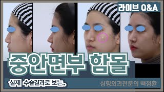 [ENG SUB] 중안면부 함몰, 꺼짐 환자의 실제 수술 결과