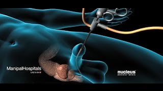 Prostate Removal Surgery - TURP