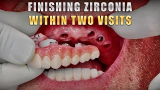 Finishing Full-Arch Zirconia Implants  In Two Visits